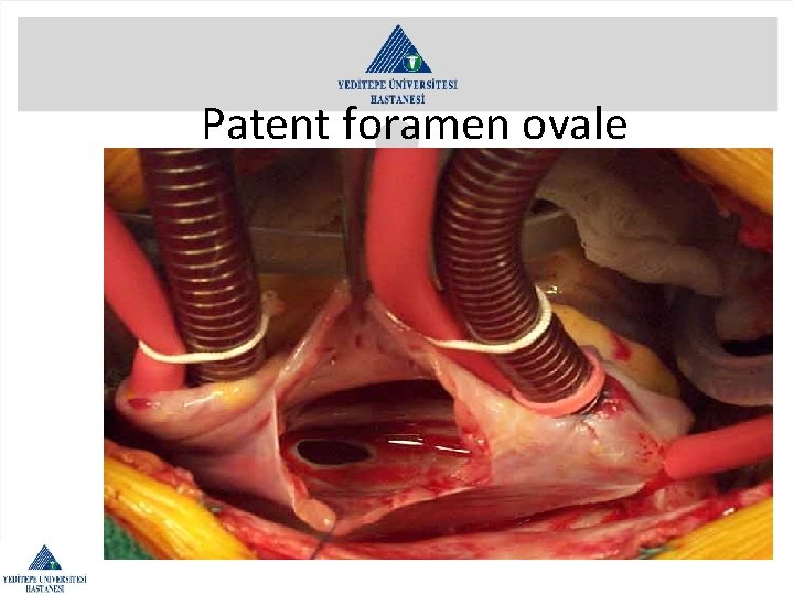 Patent foramen ovale 