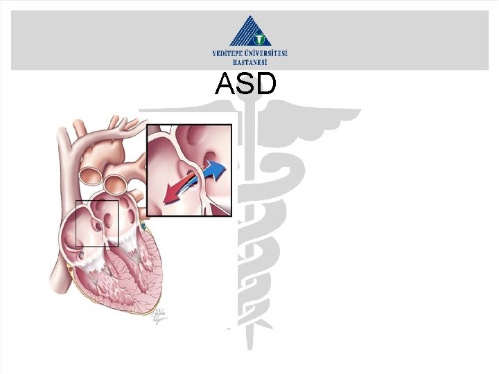 ASD 