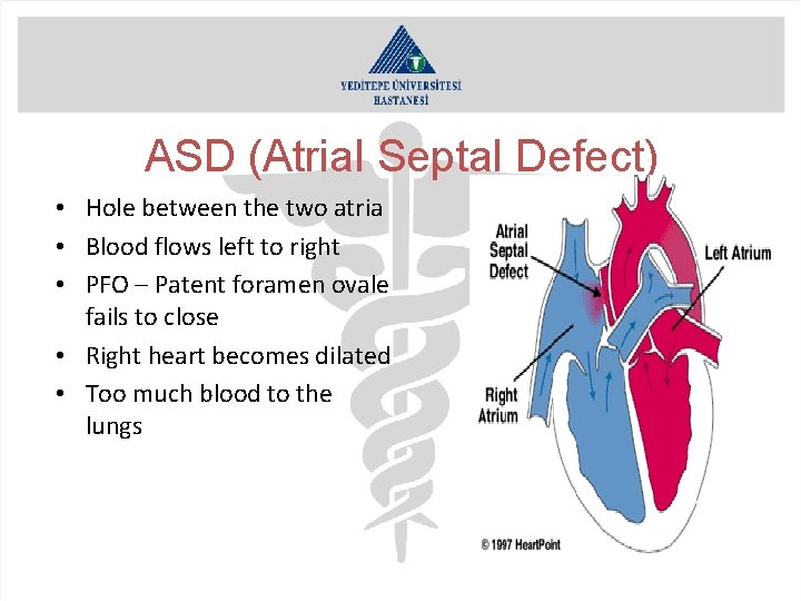 ASD (Atrial Septal Defect) • Hole between the two atria • Blood flows left