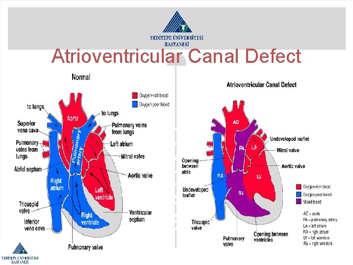 Atrioventricular Canal Defect 