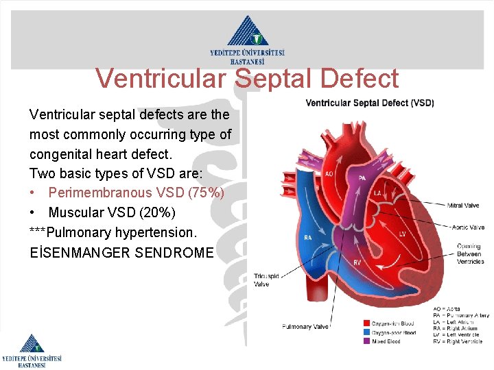 Ventricular Septal Defect Ventricular septal defects are the most commonly occurring type of congenital