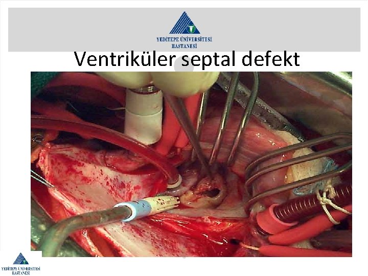 Ventriküler septal defekt 