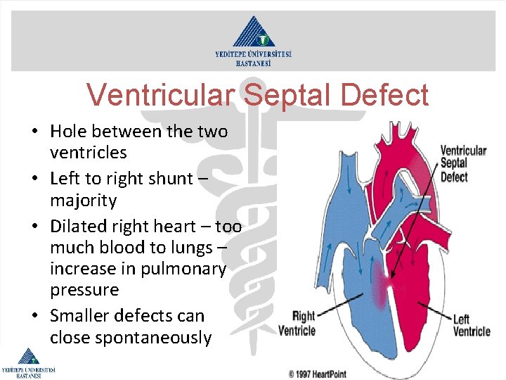 Ventricular Septal Defect • Hole between the two ventricles • Left to right shunt