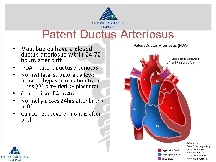 Patent Ductus Arteriosus • Most babies have a closed ductus arteriosus within 24 -72