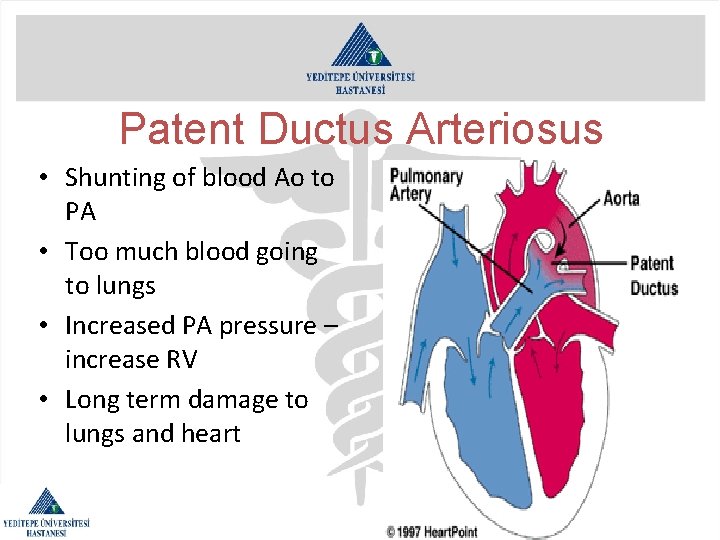 Patent Ductus Arteriosus • Shunting of blood Ao to PA • Too much blood