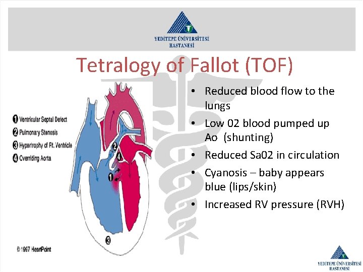Tetralogy of Fallot (TOF) • Reduced blood flow to the lungs • Low 02