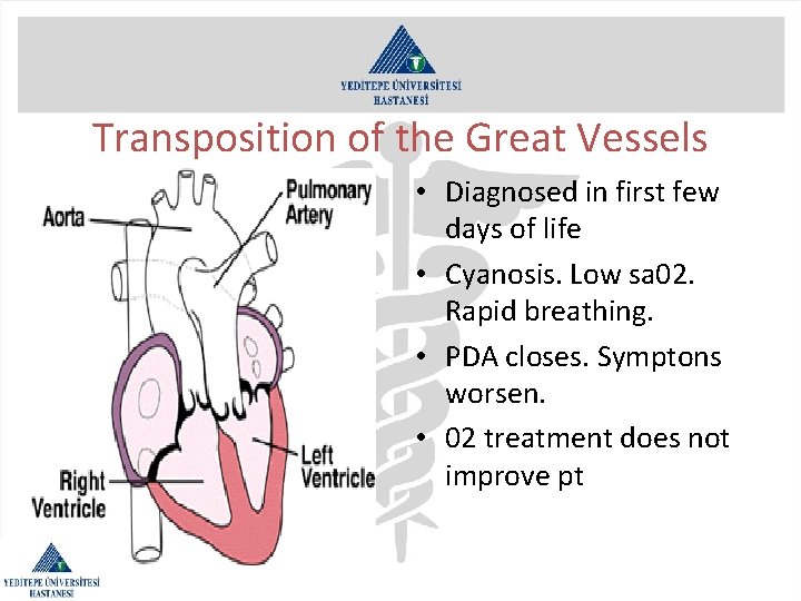 Transposition of the Great Vessels • Diagnosed in first few days of life •
