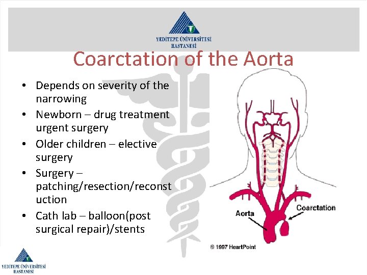 Coarctation of the Aorta • Depends on severity of the narrowing • Newborn –