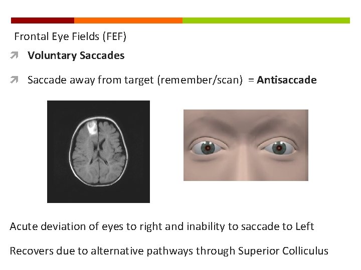 Frontal Eye Fields (FEF) Voluntary Saccades Saccade away from target (remember/scan) = Antisaccade Acute