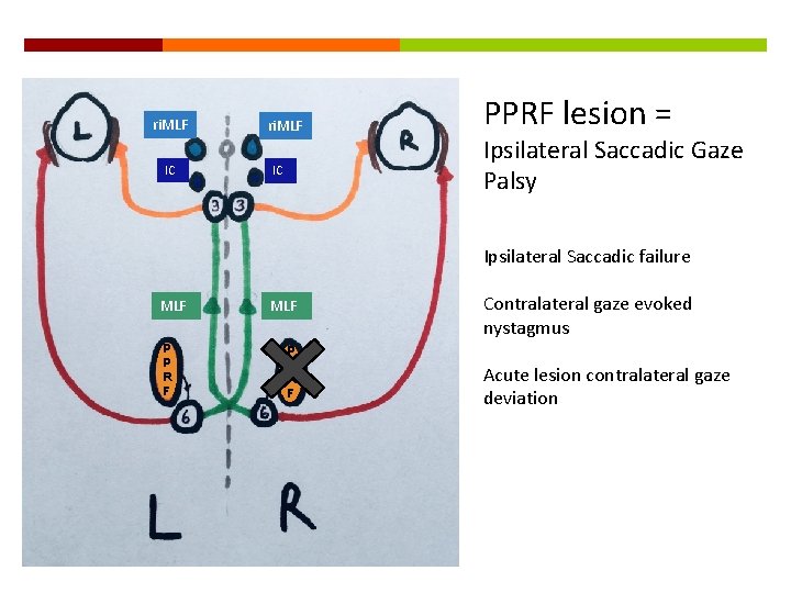 ri. MLF IC PPRF lesion = Ipsilateral Saccadic Gaze Palsy Ipsilateral Saccadic failure MLF