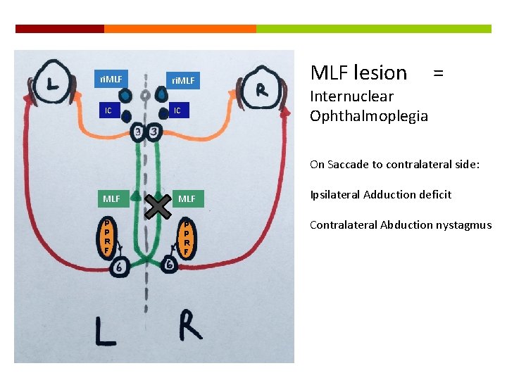 ri. MLF IC MLF lesion Internuclear Ophthalmoplegia = On Saccade to contralateral side: MLF