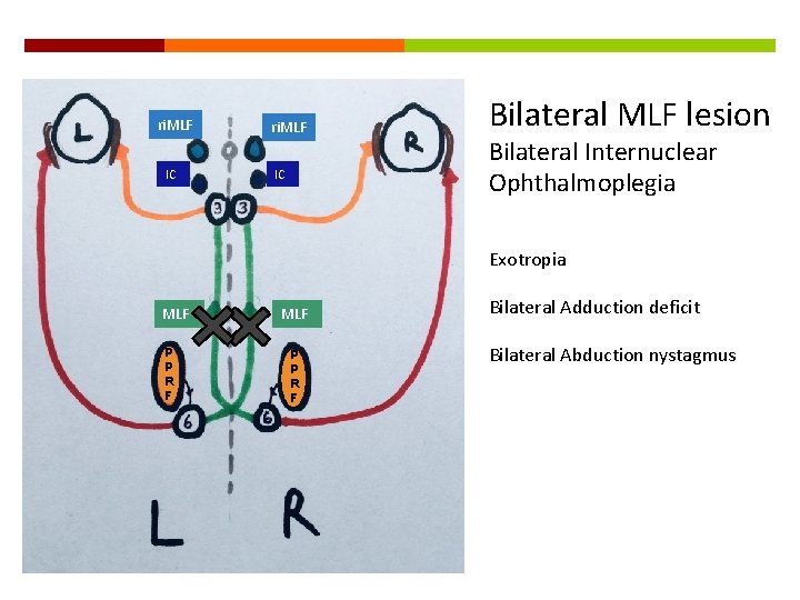 ri. MLF IC Bilateral MLF lesion Bilateral Internuclear Ophthalmoplegia Exotropia MLF P P R