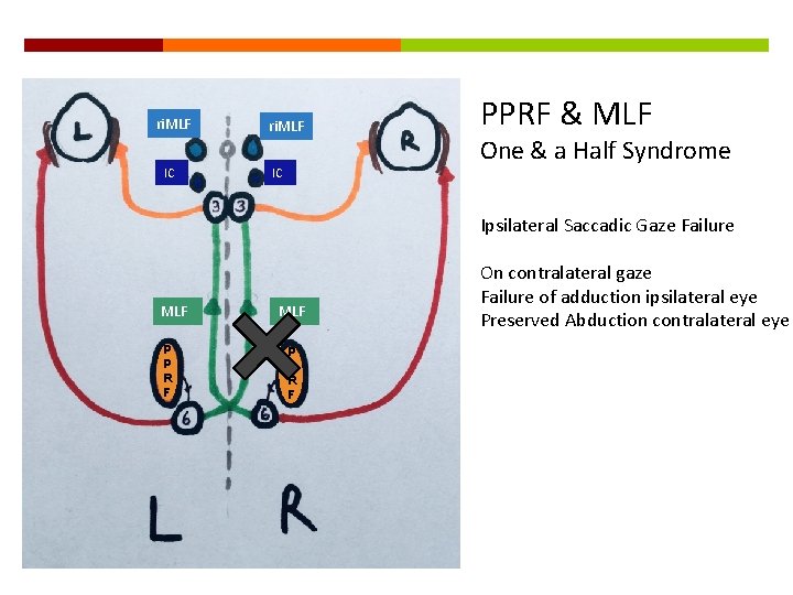 ri. MLF IC PPRF & MLF One & a Half Syndrome Ipsilateral Saccadic Gaze