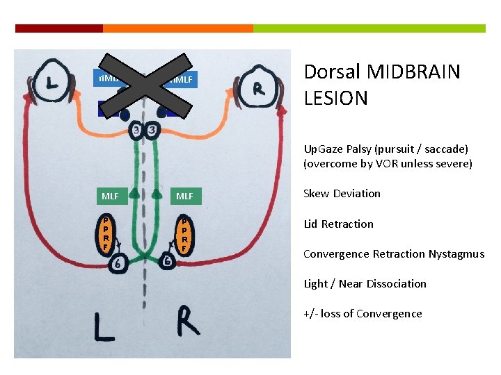 ri. MLF IC Dorsal MIDBRAIN LESION Up. Gaze Palsy (pursuit / saccade) (overcome by