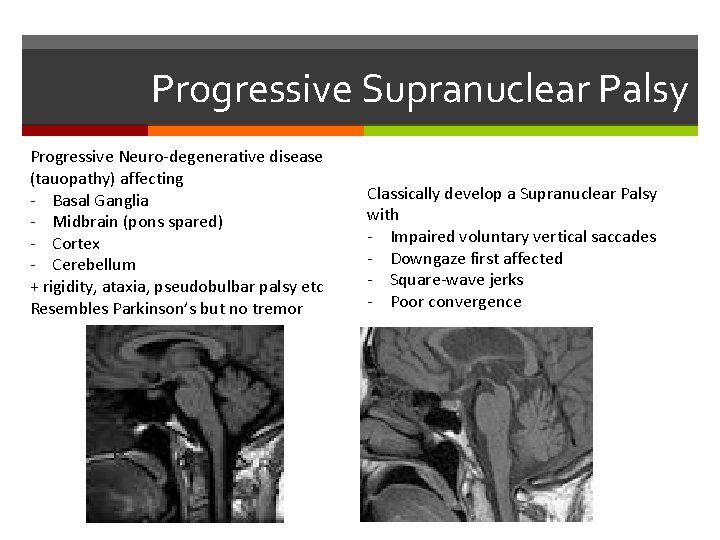 Progressive Supranuclear Palsy Progressive Neuro-degenerative disease (tauopathy) affecting - Basal Ganglia - Midbrain (pons