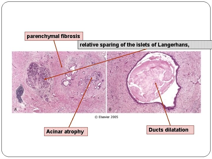 parenchymal fibrosis relative sparing of the islets of Langerhans, Acinar atrophy Ducts dilatation 