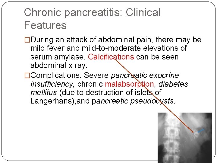 Chronic pancreatitis: Clinical Features �During an attack of abdominal pain, there may be mild