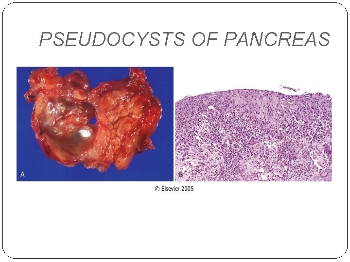 PSEUDOCYSTS OF PANCREAS 