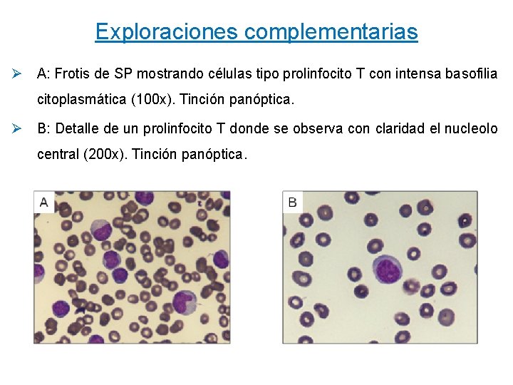 Exploraciones complementarias Ø A: Frotis de SP mostrando células tipo prolinfocito T con intensa