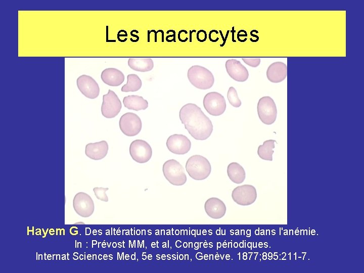 Les macrocytes Hayem G. Des altérations anatomiques du sang dans l'anémie. In : Prévost