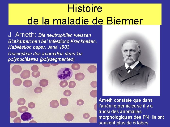 Histoire de la maladie de Biermer J. Arneth: Die neutrophilen weissen Blutkärperchen bei Infektions-Krankheiten.