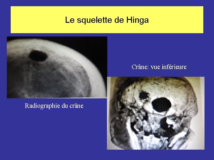 Le squelette de Hinga Crâne: vue inférieure Radiographie du crâne 