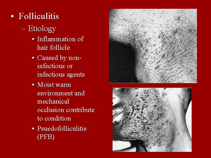  • Folliculitis – Etiology • Inflammation of hair follicle • Caused by noninfectious