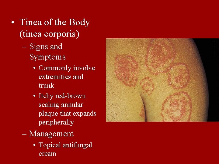  • Tinea of the Body (tinea corporis) – Signs and Symptoms • Commonly