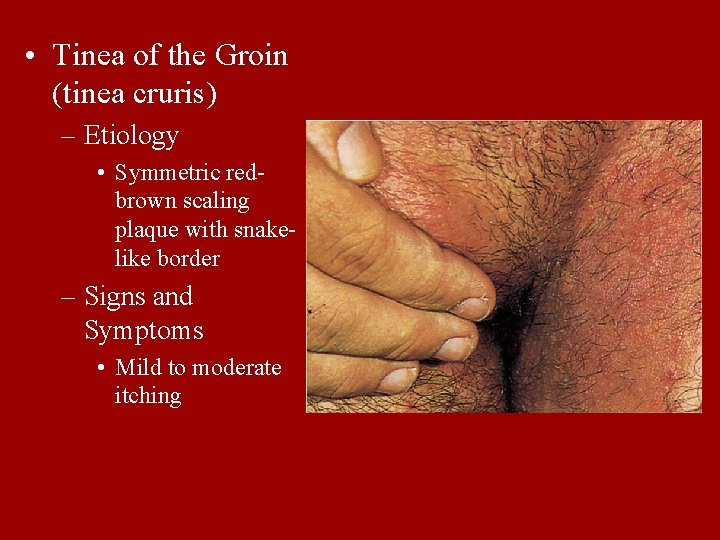  • Tinea of the Groin (tinea cruris) – Etiology • Symmetric redbrown scaling