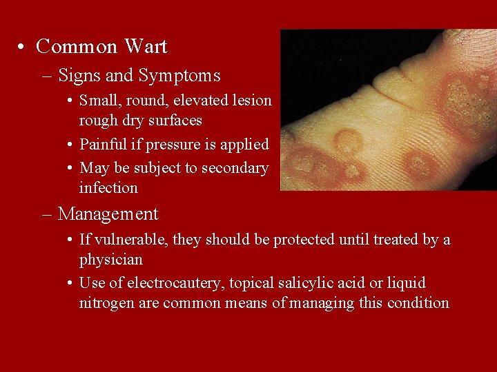  • Common Wart – Signs and Symptoms • Small, round, elevated lesion rough