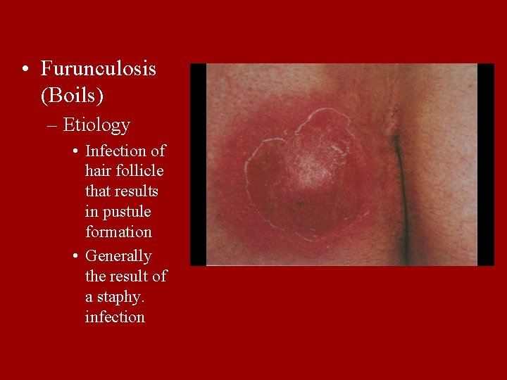  • Furunculosis (Boils) – Etiology • Infection of hair follicle that results in