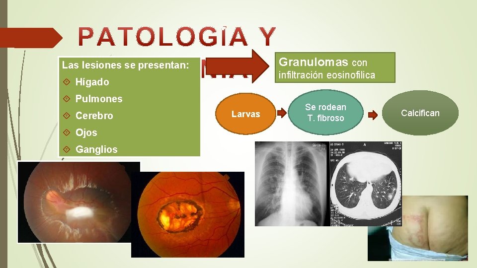 Granulomas con Las lesiones se presentan: infiltración eosinofilica Hígado Pulmones Cerebro Ojos Ganglios Larvas