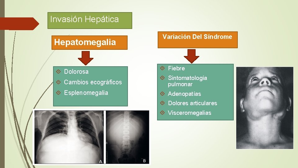 Invasión Hepática Hepatomegalia Dolorosa Variación Del Síndrome Fiebre Cambios ecográficos Sintomatología pulmonar Esplenomegalia Adenopatías