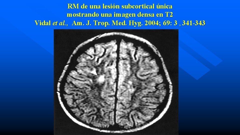 RM de una lesión subcortical única mostrando una imagen densa en T 2 Vidal