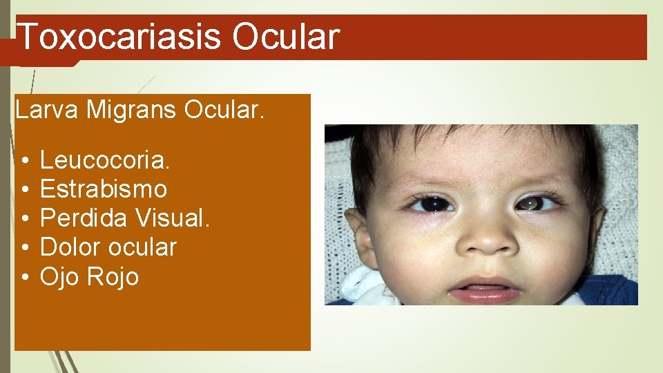 Toxocariasis Ocular Larva Migrans Ocular. • • • Leucocoria. Estrabismo Perdida Visual. Dolor ocular