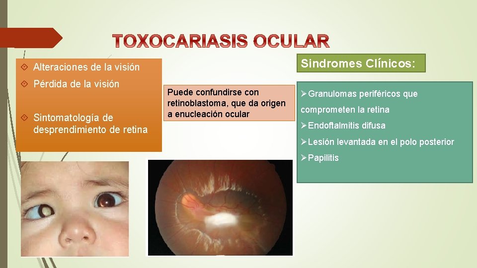 Sindromes Clínicos: Alteraciones de la visión Pérdida de la visión Sintomatología de desprendimiento de