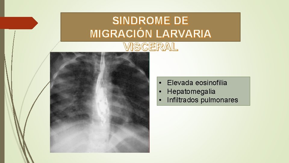 SINDROME DE MIGRACIÓN LARVARIA VISCERAL • Elevada eosinofilia • Hepatomegalia • Infiltrados pulmonares 