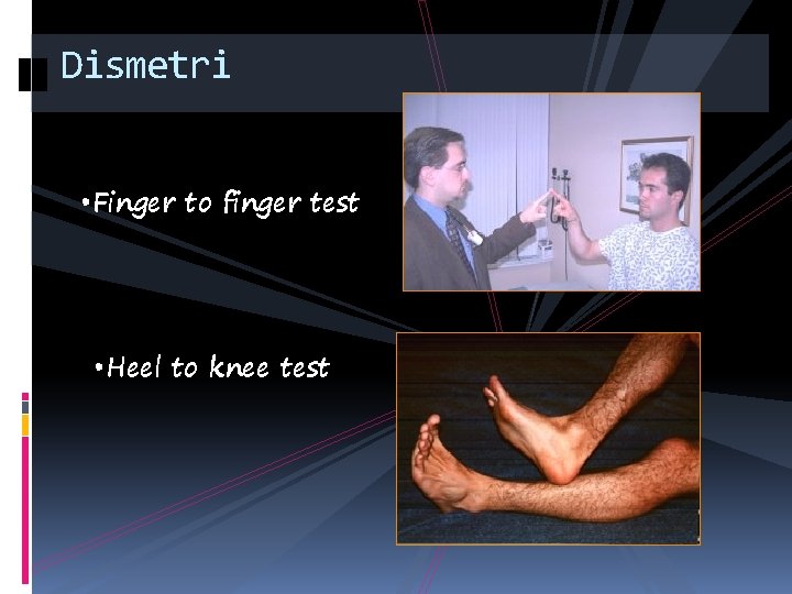 Dismetri • Finger to finger test • Heel to knee test 