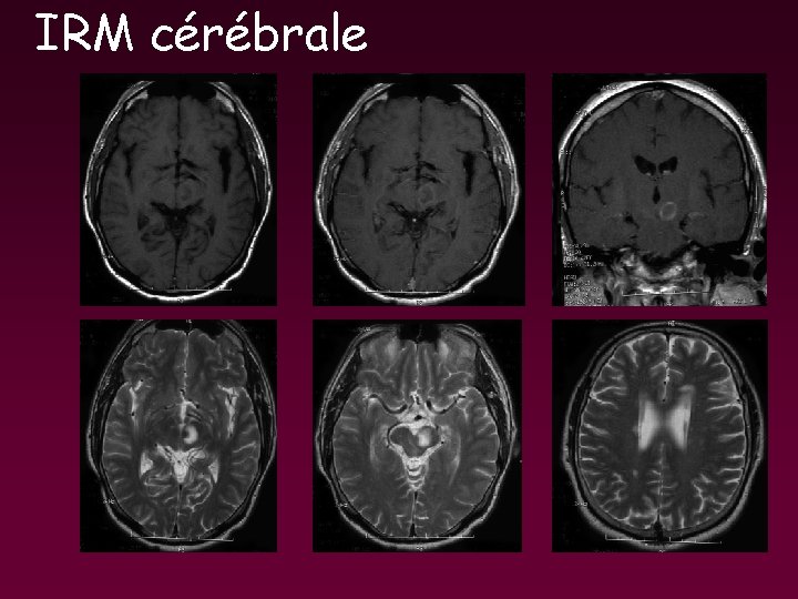 IRM cérébrale IRM cérébrale
