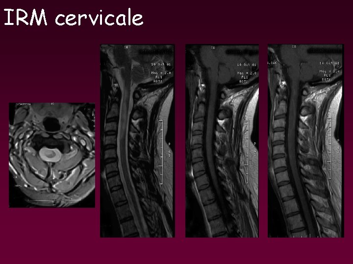 IRM cervicale IRM cervicale