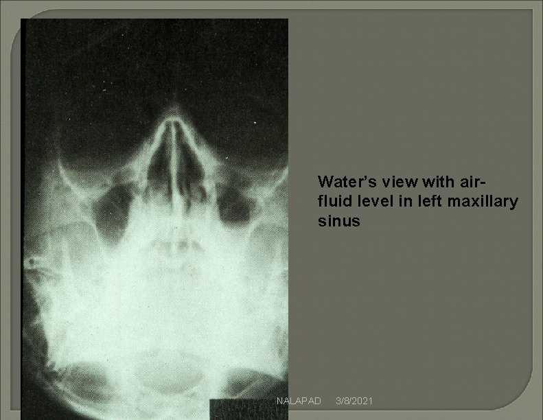 Water’s view with airfluid level in left maxillary sinus NALAPAD 3/8/2021 Water’s view with airfluid level in left maxillary sinus NALAPAD 3/8/2021
