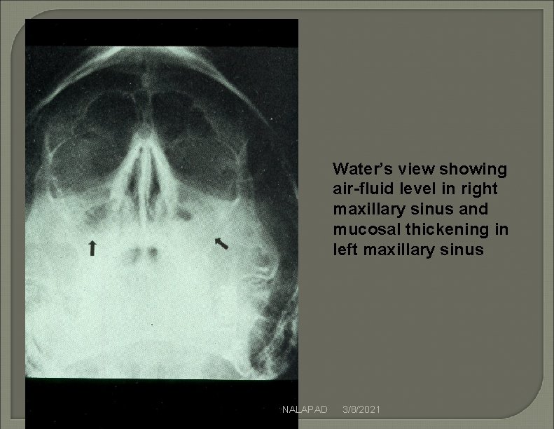 Water’s view showing air-fluid level in right maxillary sinus and mucosal thickening in left Water’s view showing air-fluid level in right maxillary sinus and mucosal thickening in left