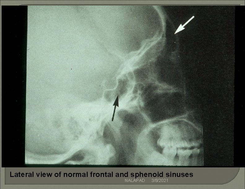 Lateral view of normal frontal and sphenoid sinuses NALAPAD 3/8/2021 Lateral view of normal frontal and sphenoid sinuses NALAPAD 3/8/2021