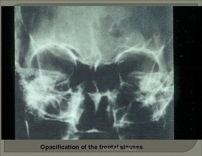 Opacification of the frontal NALAPAD sinuses 3/8/2021 Opacification of the frontal NALAPAD sinuses 3/8/2021