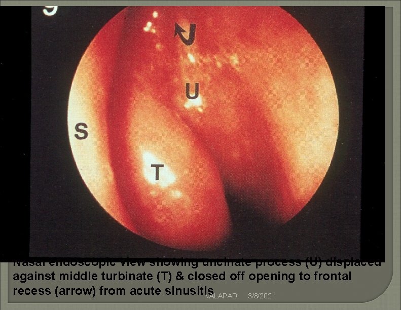 Nasal endoscopic view showing uncinate process (U) displaced against middle turbinate (T) & closed Nasal endoscopic view showing uncinate process (U) displaced against middle turbinate (T) & closed
