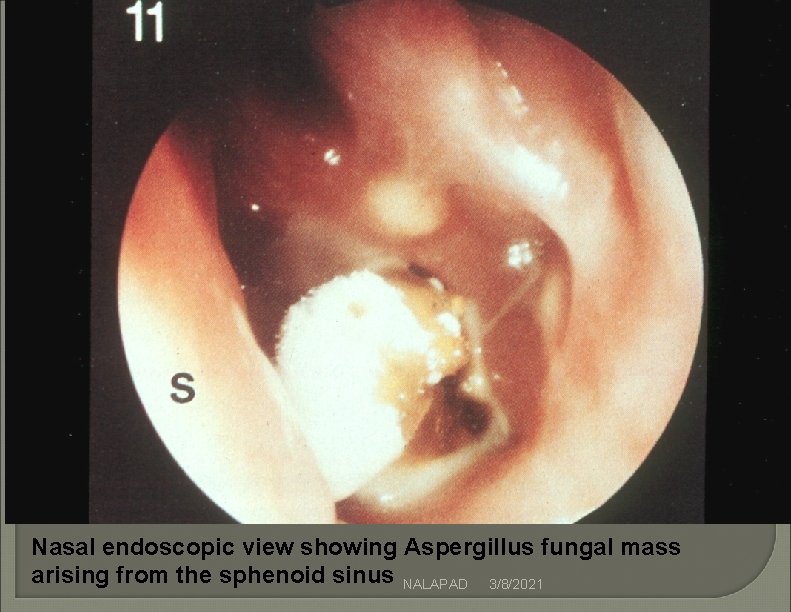 Nasal endoscopic view showing Aspergillus fungal mass arising from the sphenoid sinus NALAPAD 3/8/2021 Nasal endoscopic view showing Aspergillus fungal mass arising from the sphenoid sinus NALAPAD 3/8/2021