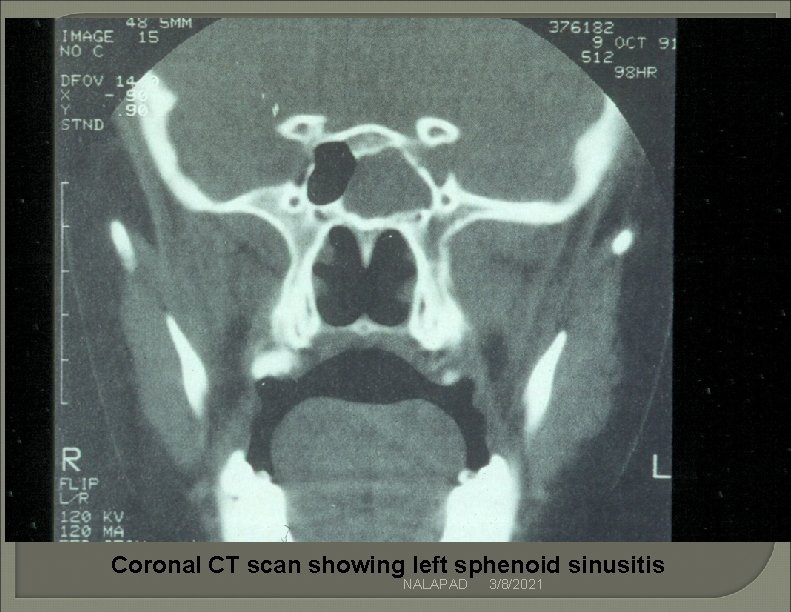 Coronal CT scan showing left sphenoid sinusitis NALAPAD 3/8/2021 Coronal CT scan showing left sphenoid sinusitis NALAPAD 3/8/2021