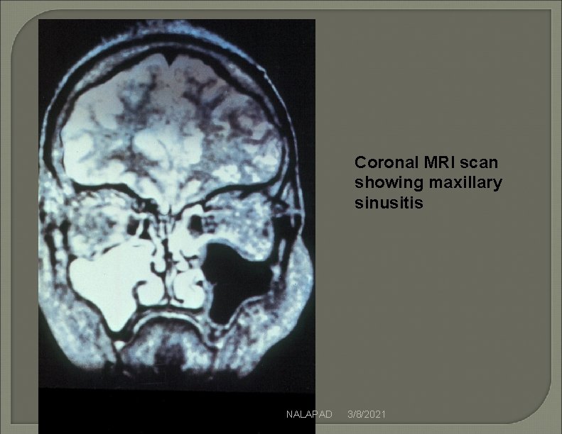 Coronal MRI scan showing maxillary sinusitis NALAPAD 3/8/2021 Coronal MRI scan showing maxillary sinusitis NALAPAD 3/8/2021