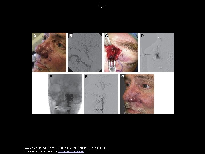 Fig. 1 Clinics in Plastic Surgery 2011 3895 -106 DOI: (10. 1016/j. cps. 2010.