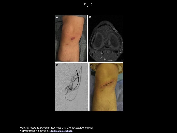 Fig. 2 Clinics in Plastic Surgery 2011 3895 -106 DOI: (10. 1016/j. cps. 2010.